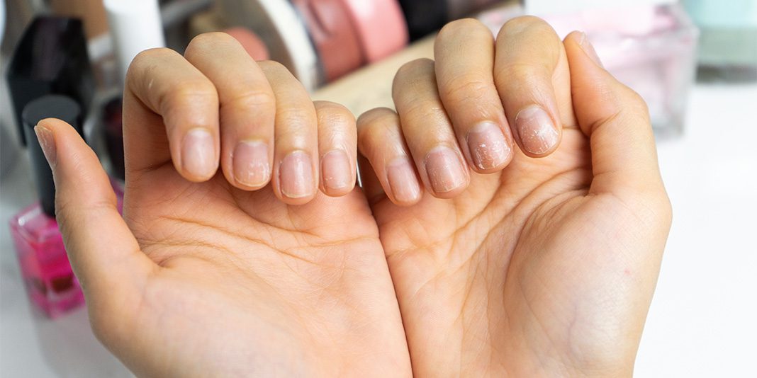 Brittle Nails Breaking Your Vibe? Here’s the Fix No One Talks About